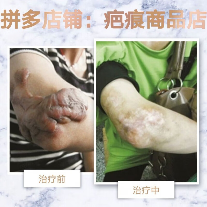 疙瘩疤痕软化液去凸疤增生硬疙瘩烫烧外伤疤胸前凸起手术耳洞增生 100