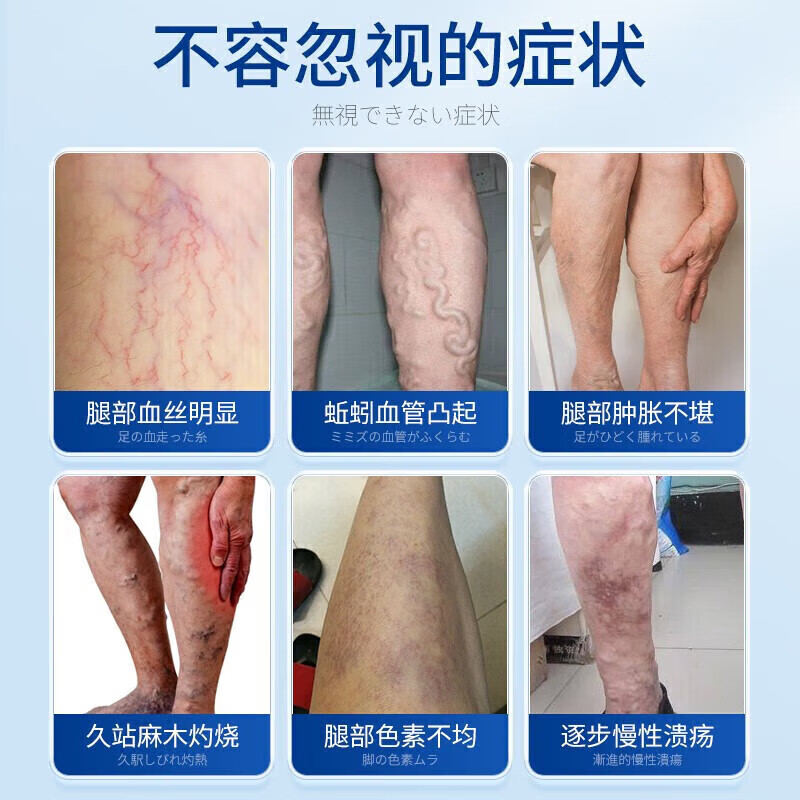 北京协和医学院静脉曲张专用膏药蚯蚓腿疏通血管堵塞进口药冷敷凝胶治疗静脉舒膏 特效一盒【曲张克星】 特效静脉曲张喷雾专用贴的