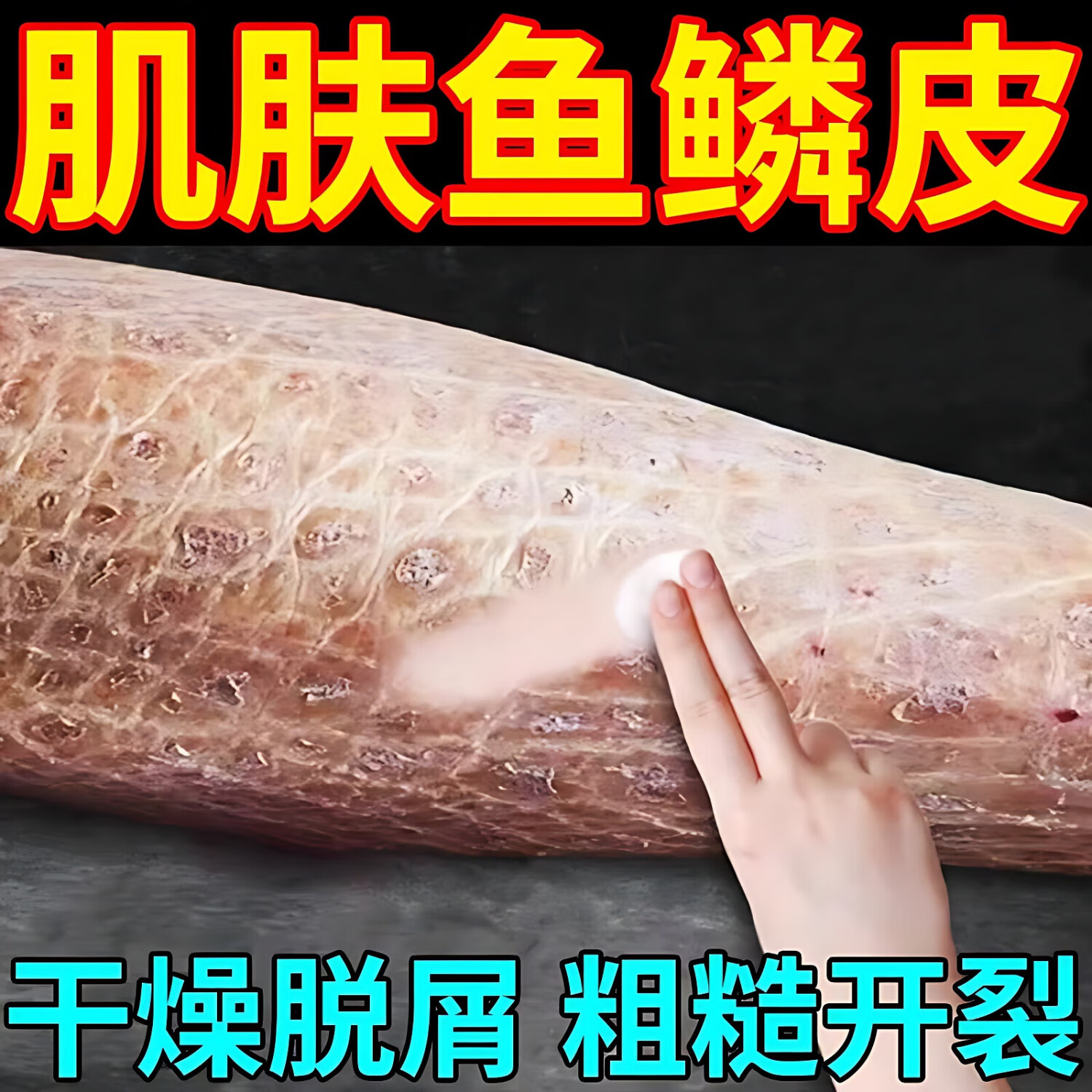鱼鳞皮肤霜去鱼鳞蛇皮病腿上干燥起皮干鳞屑脱皮全身毛囊角质化秋 一
