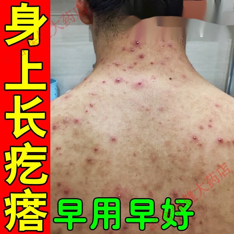 身体痒老人皮肤痒的身上起红疙瘩后背红点痘痘毛囊全身湿疹干痒杀菌