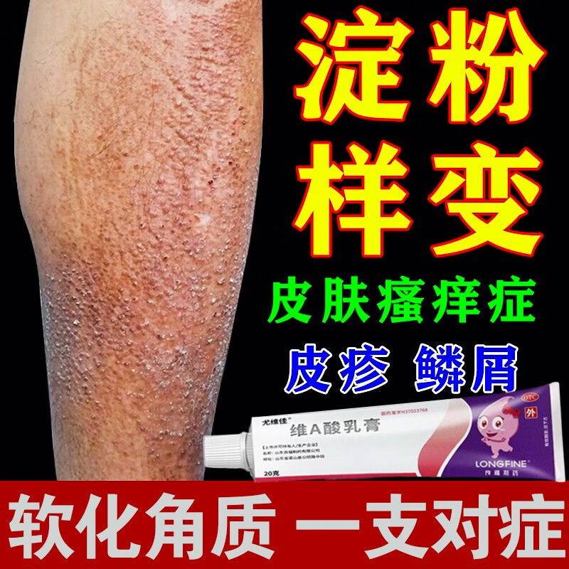 皮肤淀粉样变专用药角质老化干燥起皮手腿上粗糙瘙痒掉皮皮肤扁平苔藓