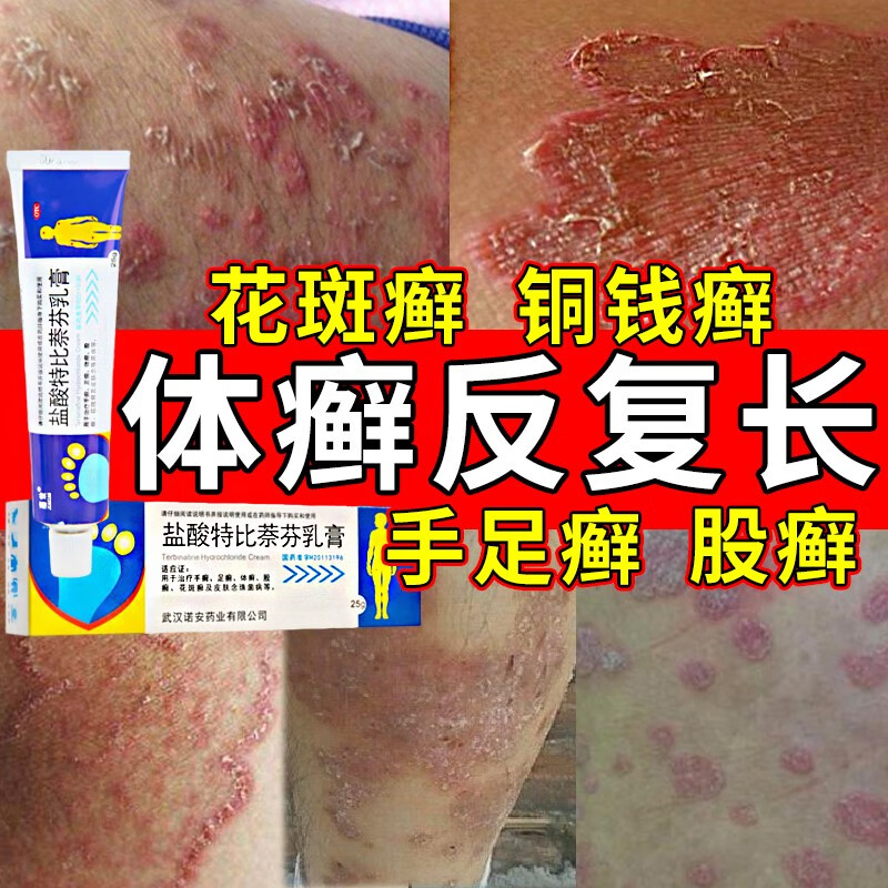 真菌感染引起的手足癣花斑癣头癣各种癣症皮肤瘙痒红斑杀菌止痒 盐酸