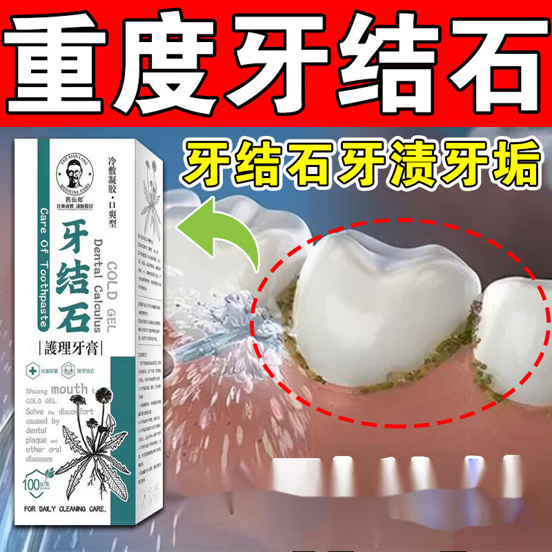 牙结石牙膏口臭黄牙结石牙渍烟渍神器牙结石溶解 单盒