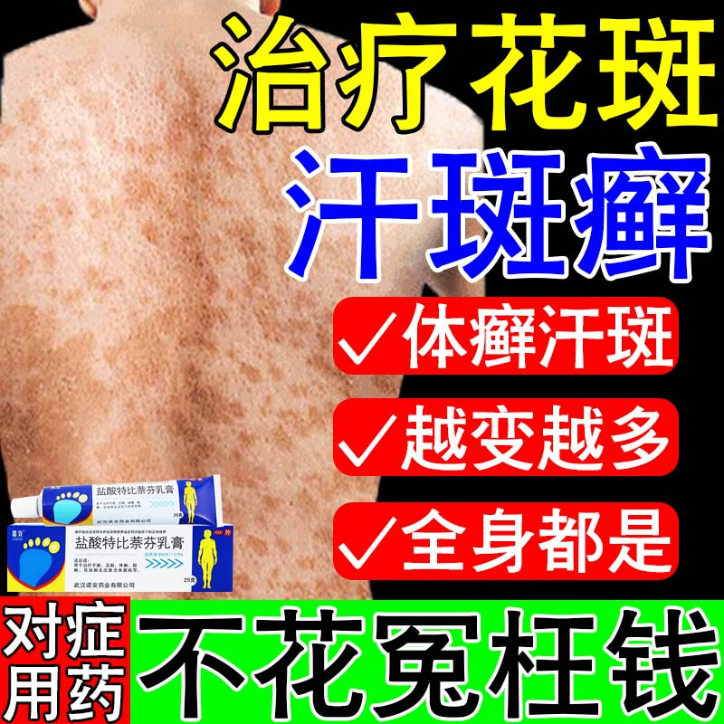 汗斑净花斑癣专用药膏 成人儿童去汗斑白斑花斑糠疹体癣皮肤瘙痒胸前