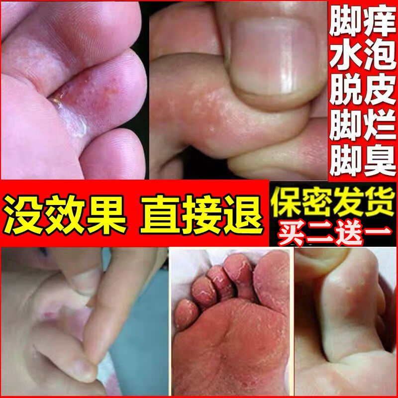 康夫康神器脱皮水泡型治脚痒止痒脚趾头套装i