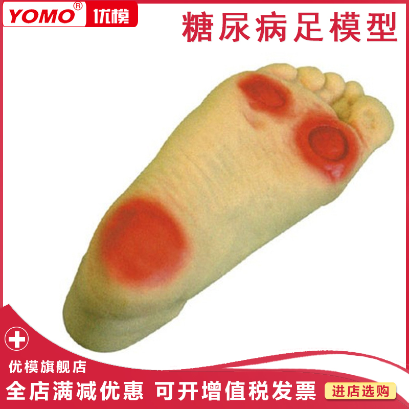优模 糖尿病足护理模型 仿真人脚模具 脚趾截肢 夏柯氏足 仿真足部