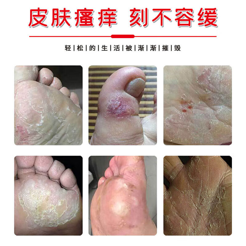 邹润安狼毒奇草乳膏 温润清肌脚痒止痒狼毒软膏 狼毒奇草膏 20g/瓶