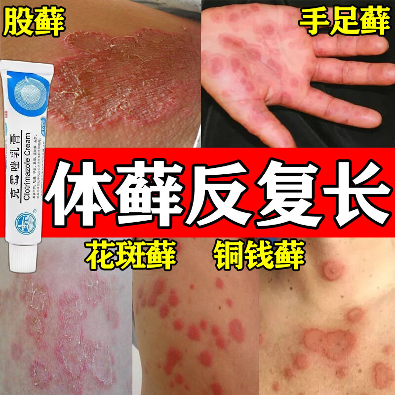 克霉唑乳膏 体癣股癣铜钱癣专用药膏 真菌感染引起的手足癣花斑癣头癣
