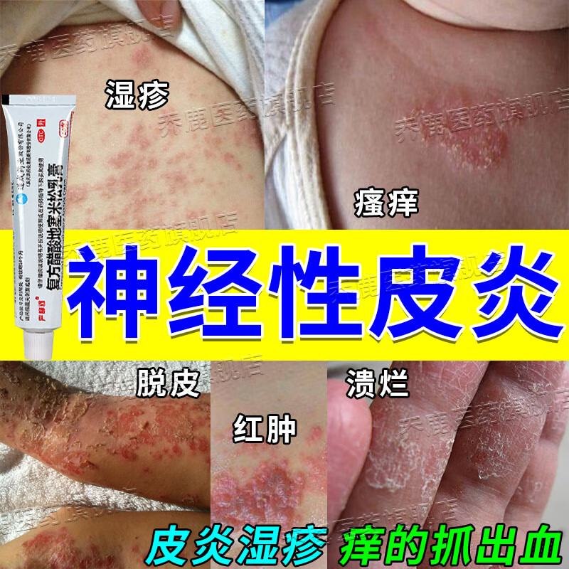 治皮肤瘙痒皮炎湿疹真菌止痒药膏 神经性皮炎皮肤过敏慢性湿疹皮癣