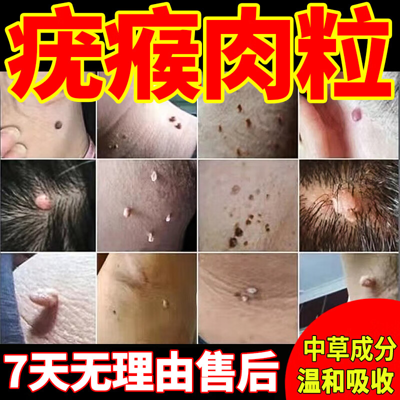 祛疣瘊子扁平疣去脖子上的小肉粒北京同仁堂清疣膏小肉粒尖锐湿疣皮肤