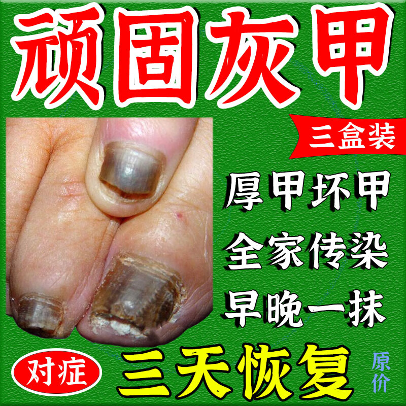 灰指甲甲沟炎特疼效药根难治正药 成人专用特别效用药 治疗甲癣灰指甲
