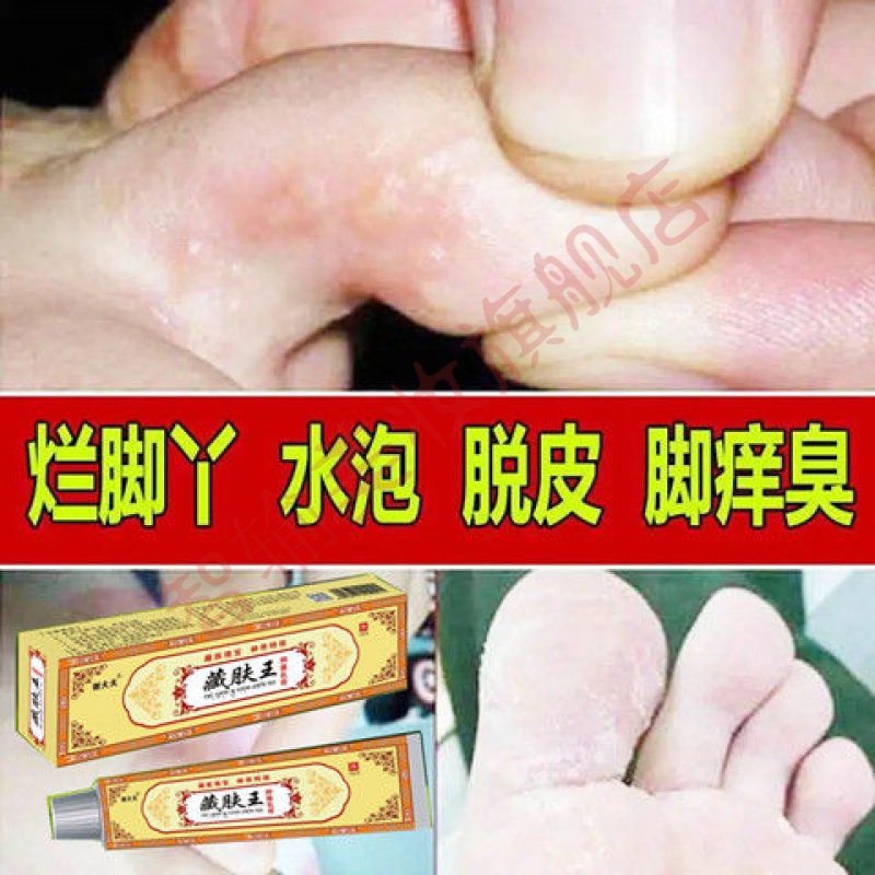 手脚脱皮止痒膏脚面溃烂泡脚水泡裂口足光臭脚痒手脱