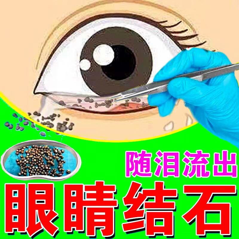 【官方直售】眼结石眼药水干眼症滴眼液迎风流泪囊炎结膜眼睛干痒 单