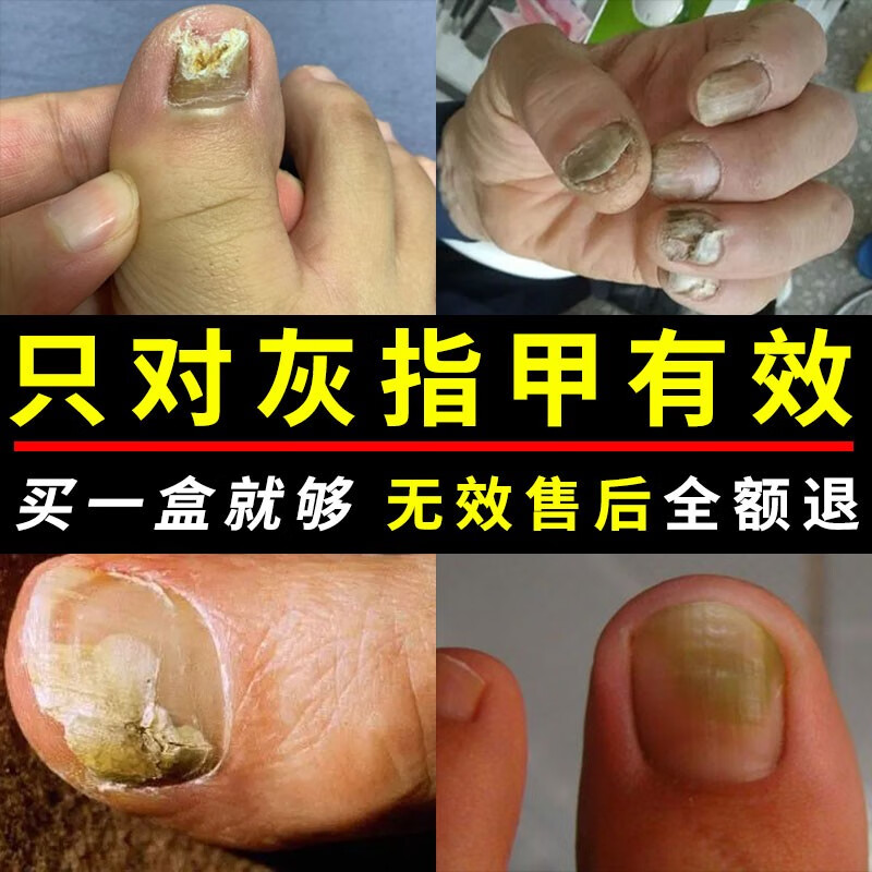 白云山【快速型】灰指甲特殊效去除甲i沟i炎增厚发黄变空中 #1