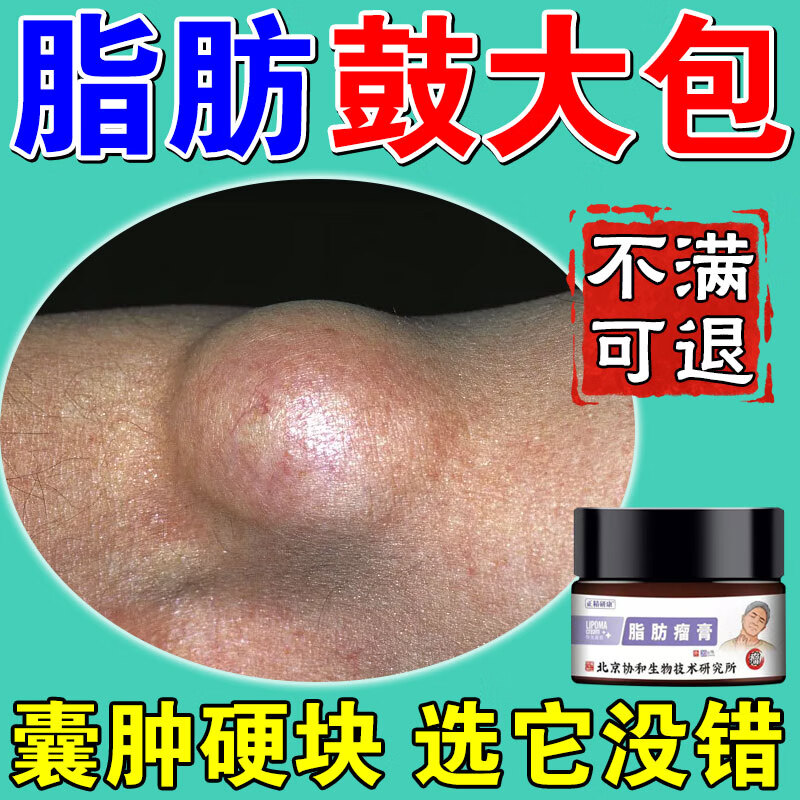 脂肪瘤专用膏药脂肪康去除膏纤维瘤脂肪瘤去除神器皮下囊肿多发性脂肪