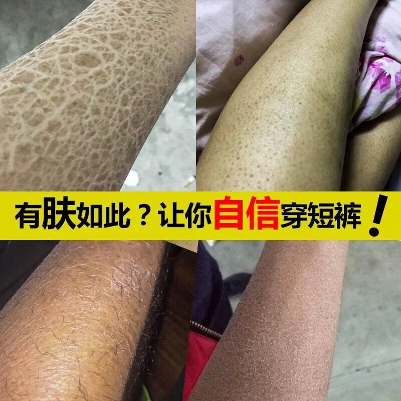 南京同仁堂祛鸡皮肤毛囊角质疙瘩大腿套装手臂身体乳精华液鱼鳞病果酸