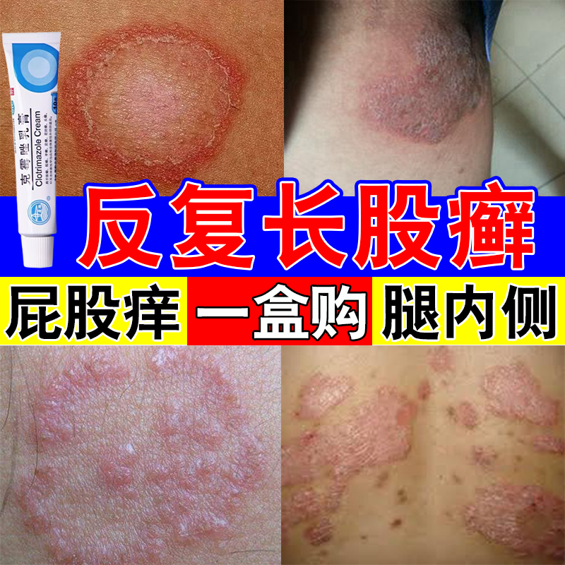 大腿内侧股癣专用药膏】潮湿闷热出汗长癣发红瘙痒红疹糜烂有异味腿裆