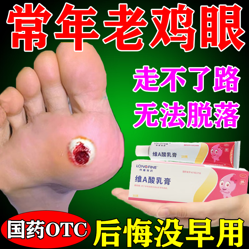 鸡眼膏 去肉刺脚后根药膏 成人脚底脚趾鸡眼跖疣瘊子老茧走路疼痛软化