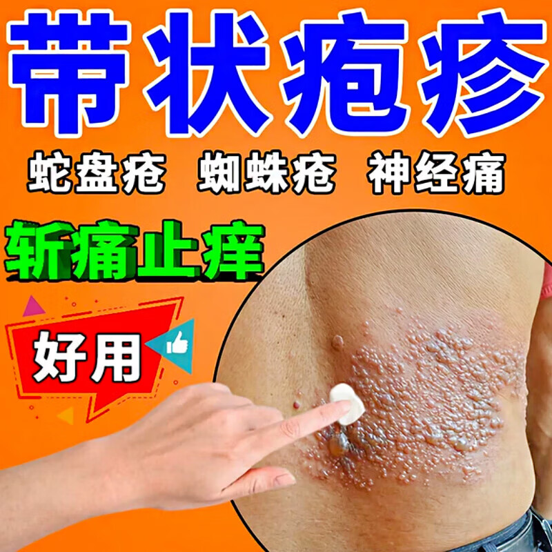 【官方直售】蛇盘疮膏带状疱后疹外用药后遗症神经痛痒蛇缠腰身水泡