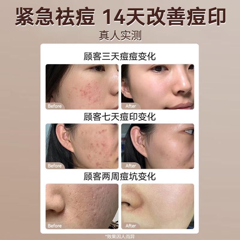 润凰德德维芙皮傲宁胶态硫祛痘膏去痘印痘坑修复青春痘壬二酸15%凝胶