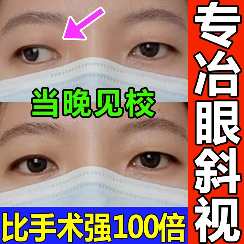 斜视器聚散球纠正眼睛内外斜视弱视斗歪眼贴视力模糊 [轻度斜视]1瓶装