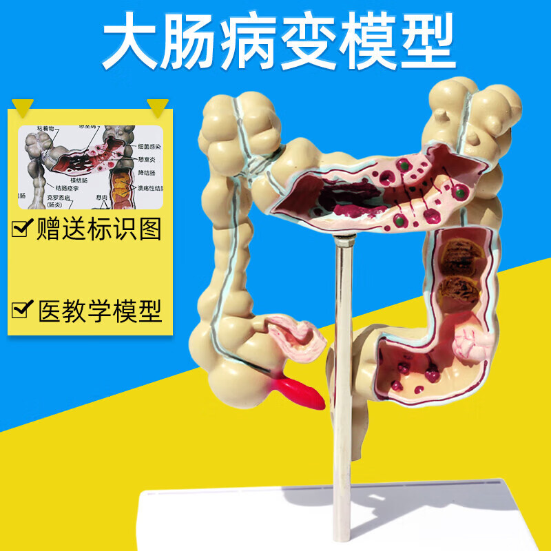 大肠病理模型大肠病变模型 肠道疾病 人体结肠病变教学模型