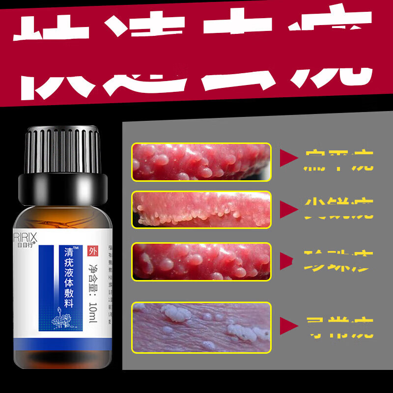 nt珍珠克珍珠l疹去除男性私处冠状沟系带样丘状粒软膏 一瓶装