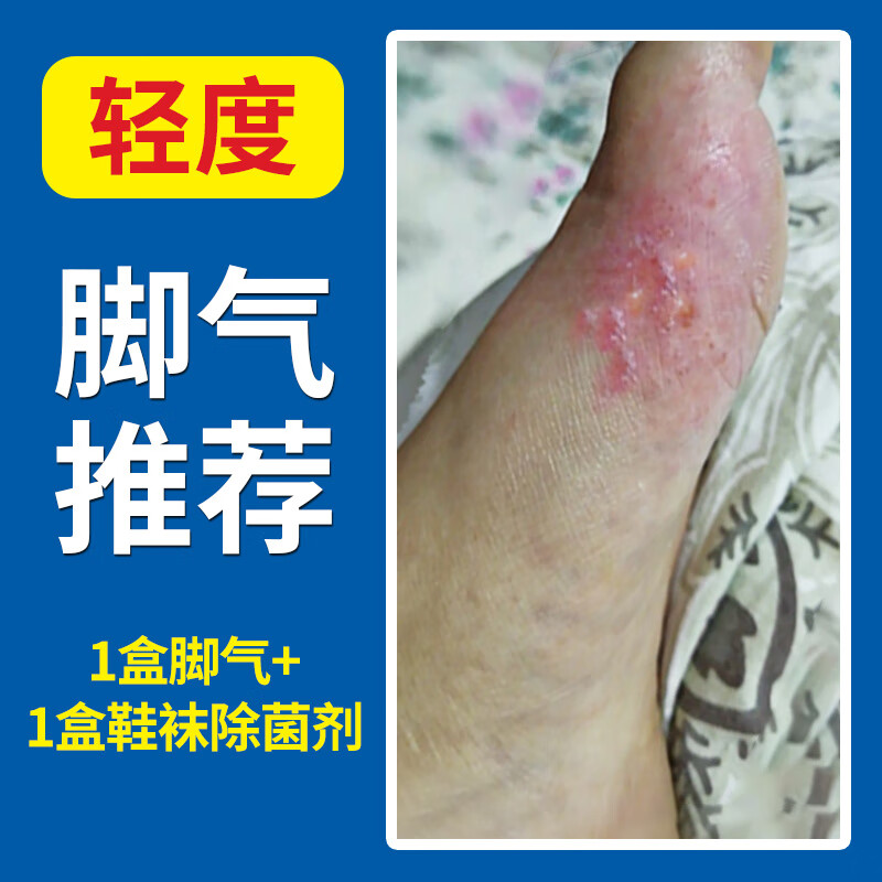 水泡糜烂专用喷雾非药治膏水泡型 【轻度脚气】1盒脚气 1盒鞋袜除菌剂