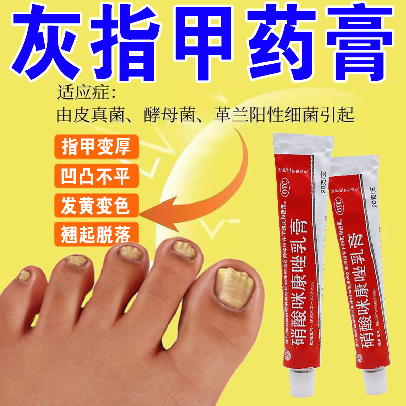 硝酸咪康唑乳膏20g 灰指甲专用药治灰指甲药膏 甲癣真菌感染指甲变色