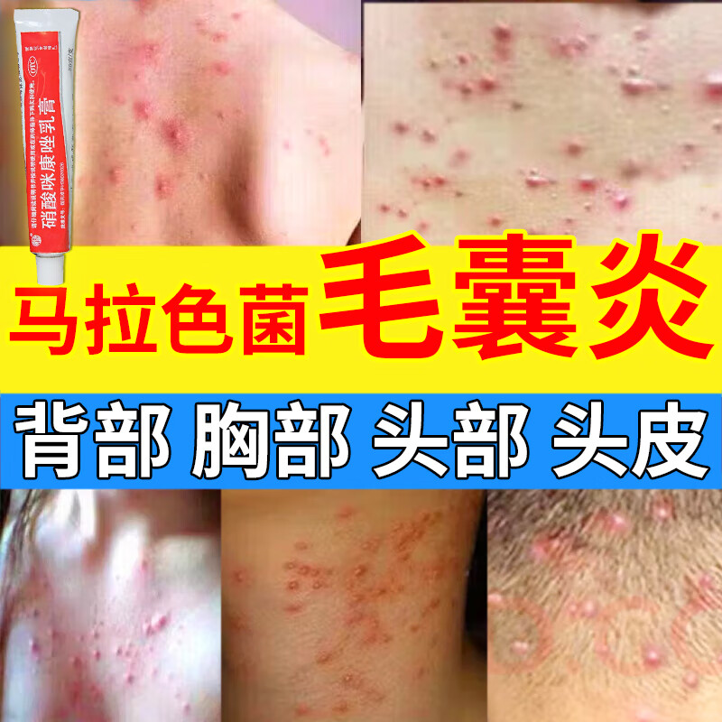 1盒装【国药甄选治毛囊炎】