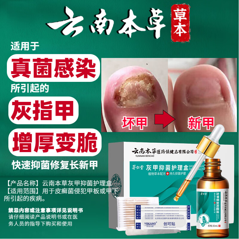 云南本草灰指甲抑菌液特殊效中草药灰甲净脱甲膏发黄增厚中空套盒30ml使用感如何?