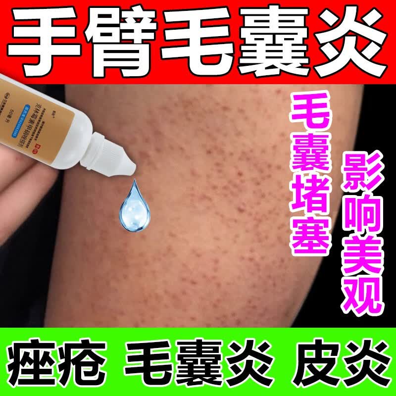 克林霉素甲硝唑搽剂治毛囊炎特效药 手臂后背祛痘 毛囊炎 长痘痘胳膊