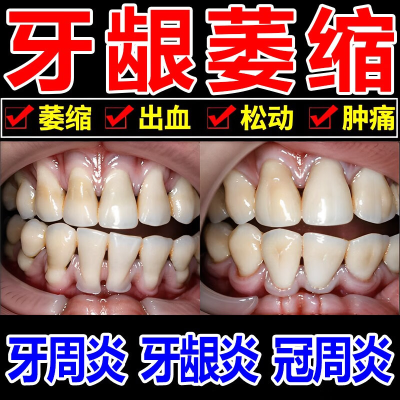 5瓶【长期牙龈萎缩牙齿松动】