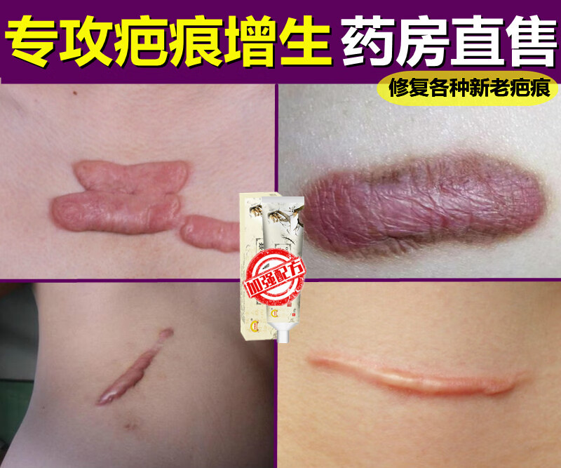 灵膏增生凸起手术旧伤疤贴沉淀疙瘩去除 官方