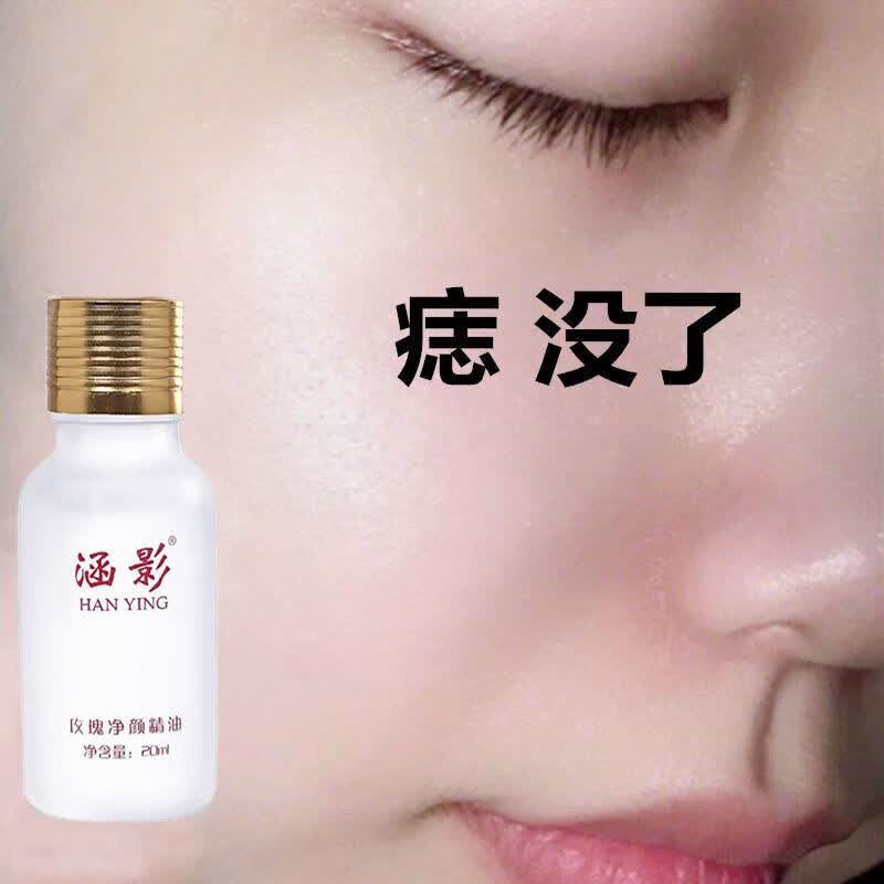 药房直售 去痣点痣去黑点苍蝇屎黑痣祛痣膏精油男女 去痣点痣水无痕去