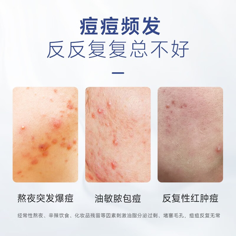 优理氏 祛痘膏青春痘淡化痘坑痘印改善粉刺调理水杨酸痘肌修护脸部净肤 【到手2支】祛痘膏20g