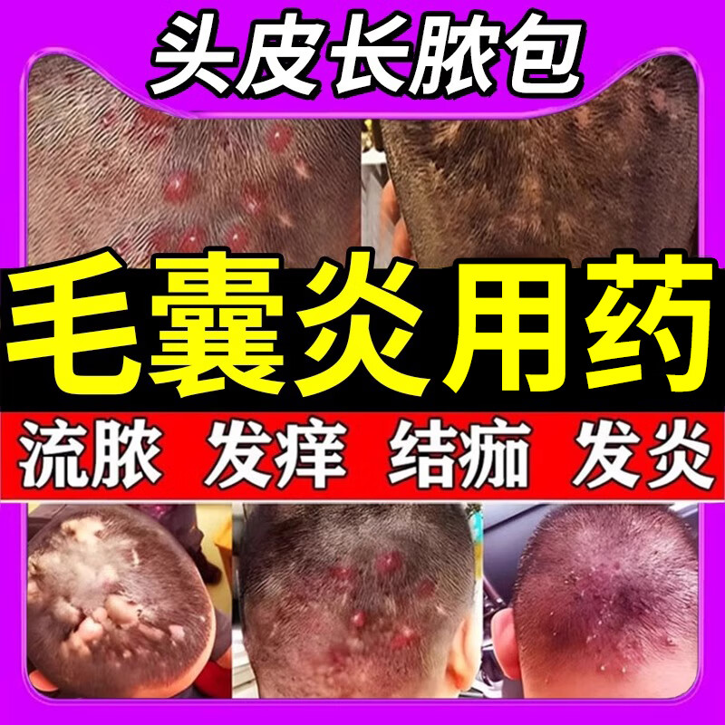 毛囊炎头部药头皮毛囊炎药头上长疙瘩脓包头皮毛囊药炎症搭配药膏皮肤