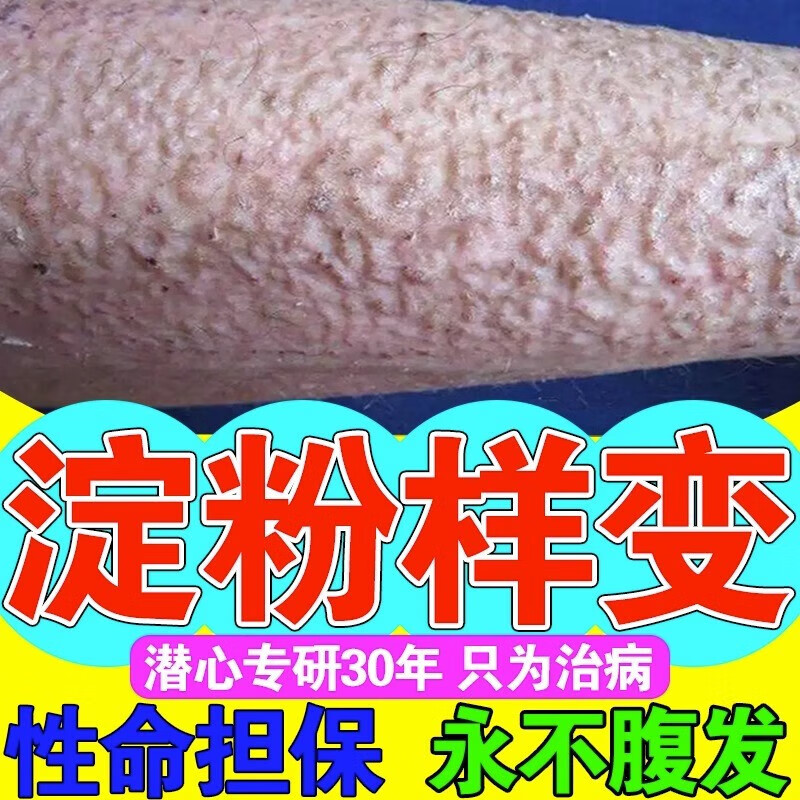 皮肤淀粉样变专用丨药腿手上粗糙苔藓斑状蛋白沉积干燥起皮止瘙痒 单