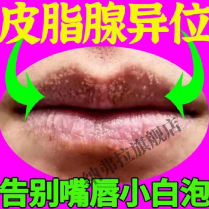 卓杰官方皮脂腺异位嘴唇白点嘴边增生白点脱皮上火红肿起泡 购3发5盒