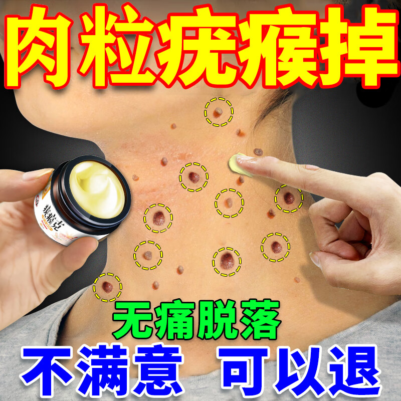 疣瘊灵去除脖子小肉粒去猴子脖子温和不留巴扁平疣尖锐湿疣清疣 一