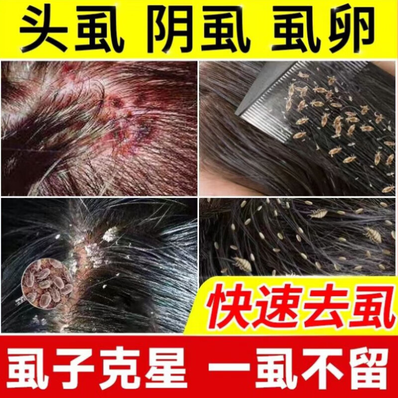 头上长虱子的症状图片