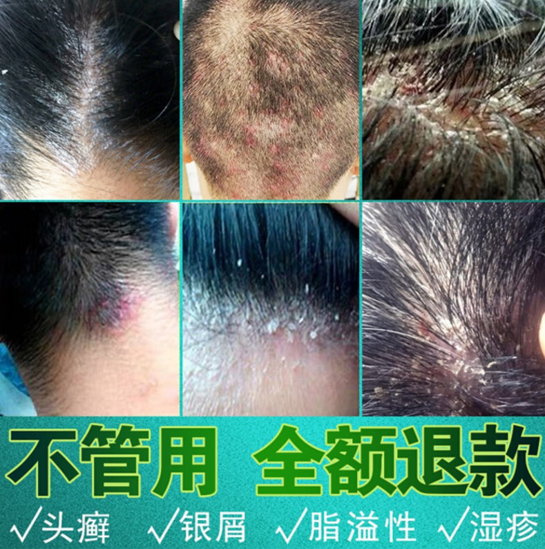 头皮l癣银l屑病专用箹l膏真菌感染治l疗头部牛皮l癣外用去头l癣l藓
