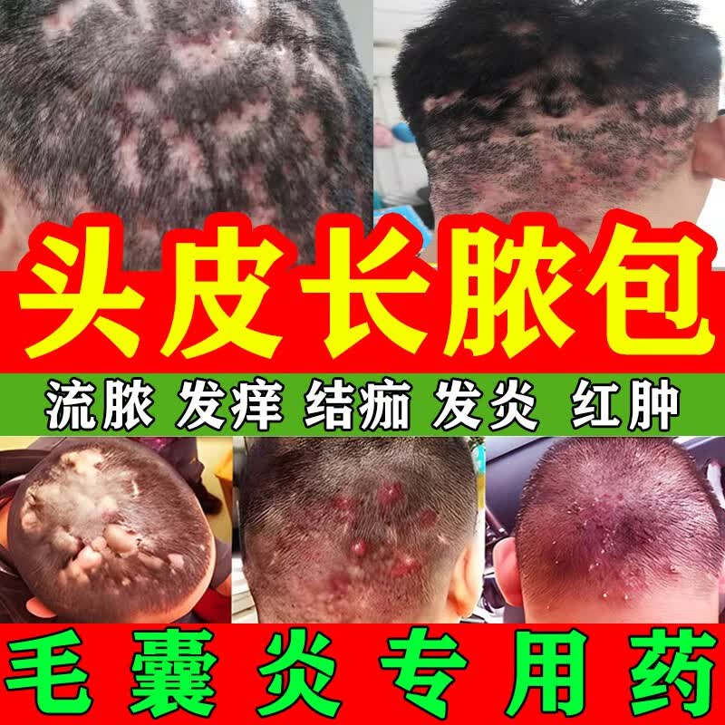 毛囊炎头部专药用真菌感染引起的毛囊炎头皮长红疙瘩脓包发痒流脓结痂