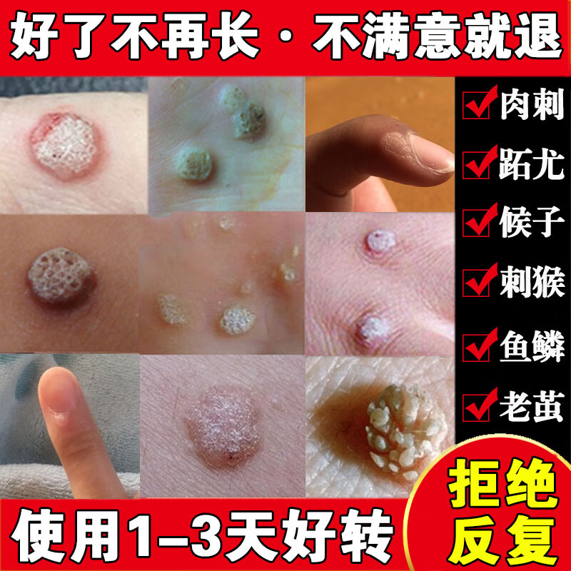 【京健康】子的药鱼鳞痣祛肉粒疙瘩治瘊子休子药刺猴药去除神器 药