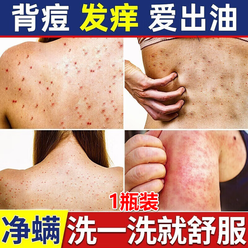熏姿颜去螨虫沐浴露男士除螨祛痘后背硫磺疙瘩止痒儿童持久留香女乳液