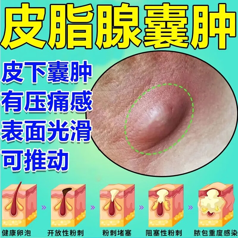 皮脂腺囊肿药膏莫匹罗星软膏治皮脂腺囊肿粉瘤痘痘去除膏消皮下脓 1盒