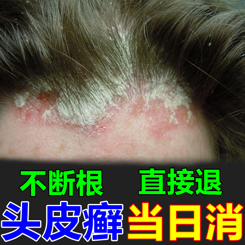 头皮癣专用膏银l屑病真菌感染治疗头部去癣外用头屑头痒药水