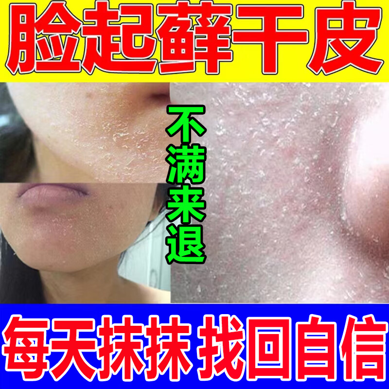 脸上皮肤干燥起皮过敏红痒脱皮起疙瘩男女通用修复鼻子下巴面部脱 单