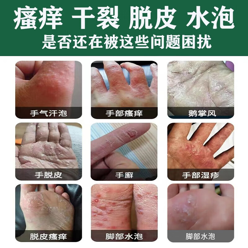 e型e型汗手指水泡脱皮鹅z掌风皮湿手脚皮l藓水. 1瓶