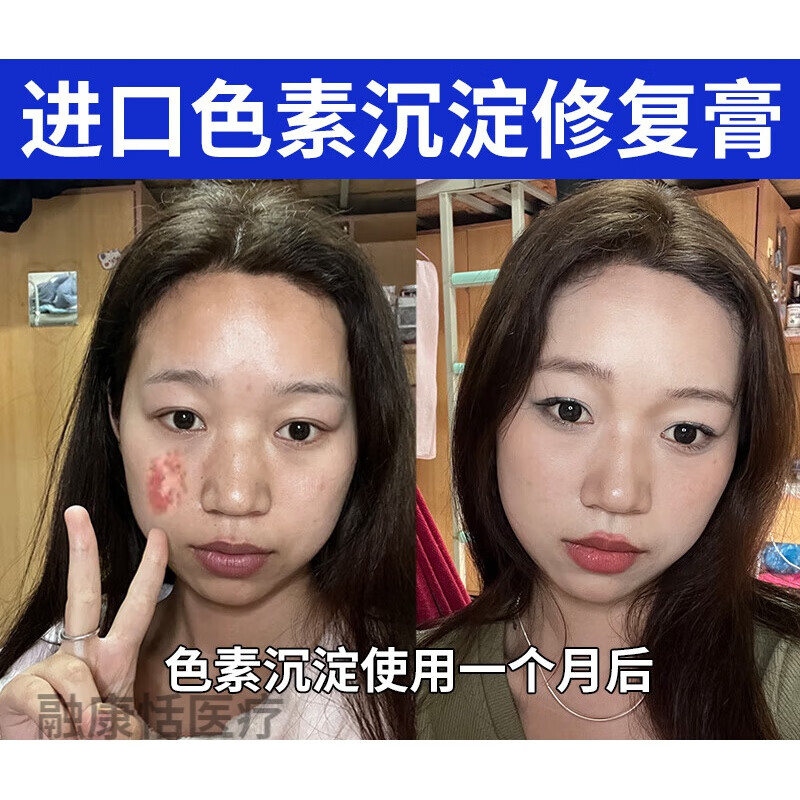 印黑色素 去沉淀烫伤印脸部沉着退嘴黑印皮肤